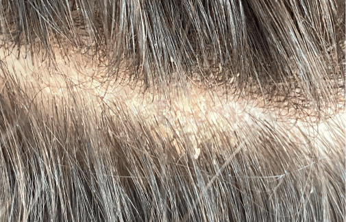 dermatitis_a-min