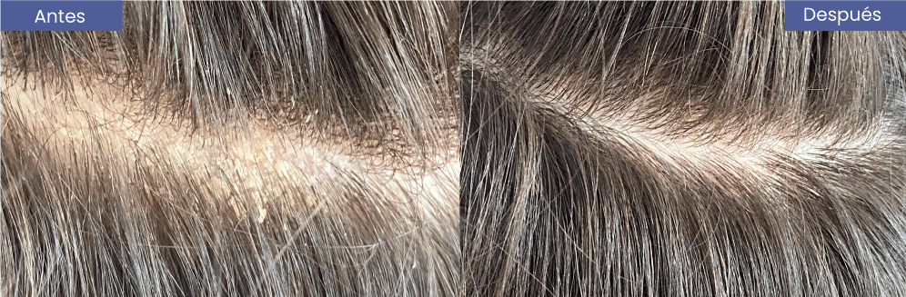dermatitis_b-min